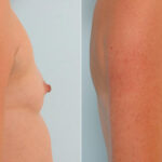 Breast Augmentation before and after photos in Houston, TX, Patient 25338