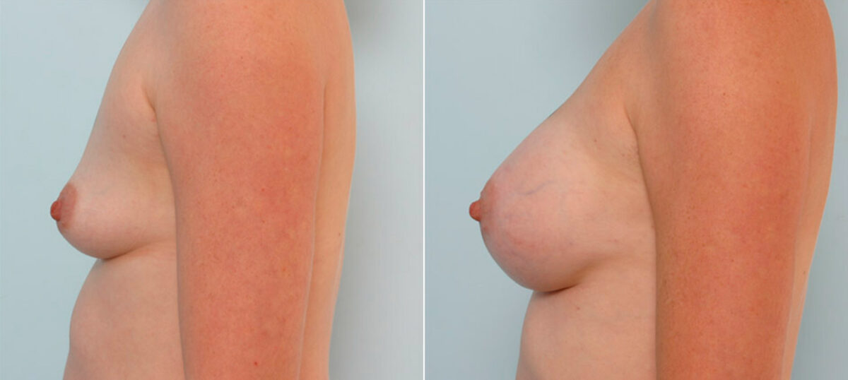 Breast Augmentation before and after photos in Houston, TX, Patient 25338