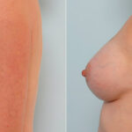 Breast Augmentation before and after photos in Houston, TX, Patient 25338