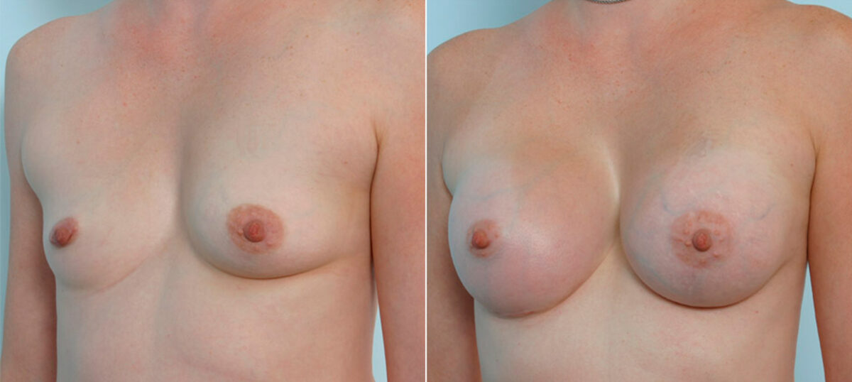 Breast Augmentation before and after photos in Houston, TX, Patient 25338