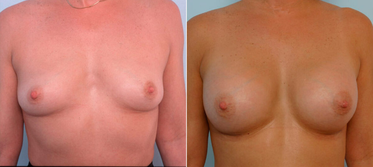 Breast Augmentation before and after photos in Houston, TX, Patient 25347