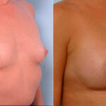 Breast Augmentation before and after photos in Houston, TX, Patient 25347