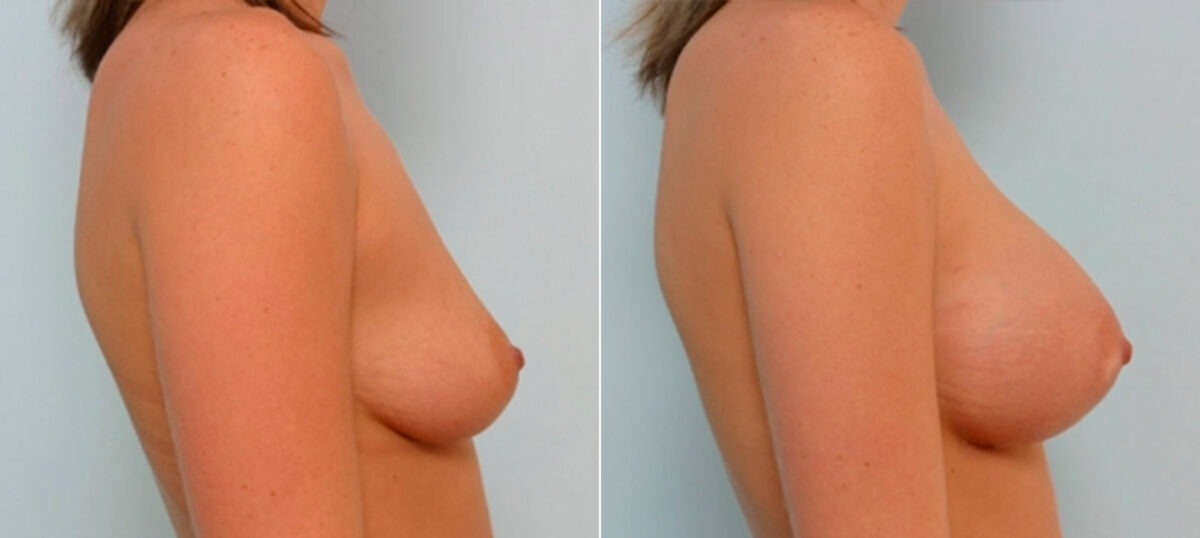 Breast Augmentation before and after photos in Houston, TX, Patient 25352