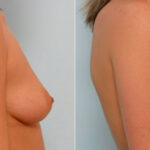Breast Augmentation before and after photos in Houston, TX, Patient 25352