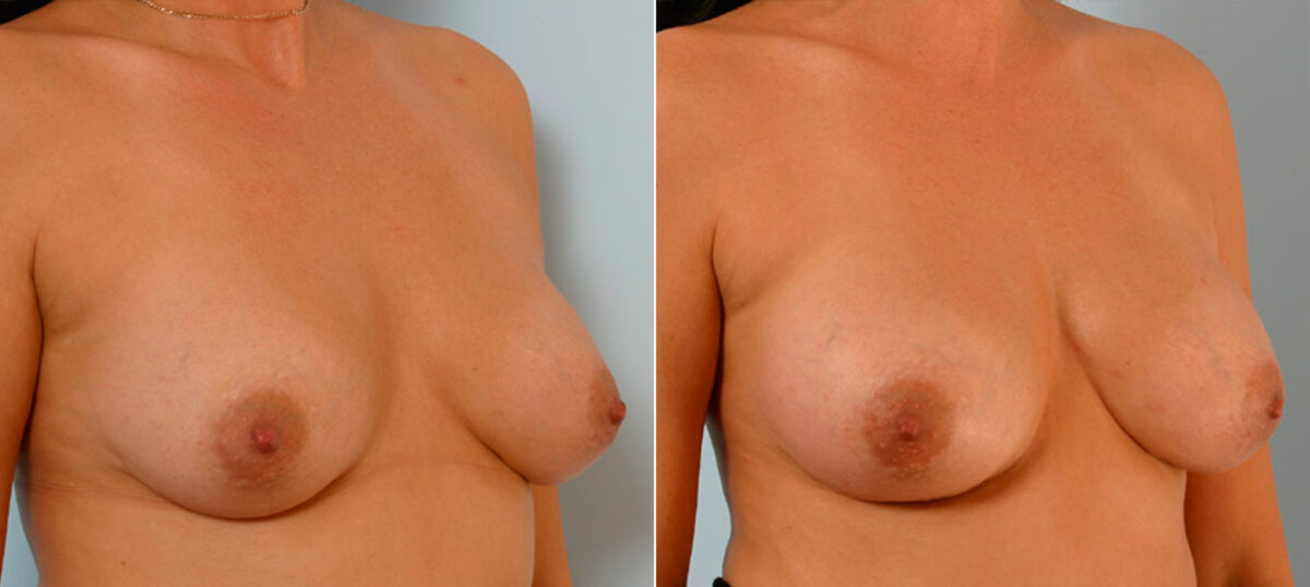 Breast Augmentation before and after photos in Houston, TX, Patient 25359