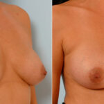 Breast Augmentation before and after photos in Houston, TX, Patient 25359