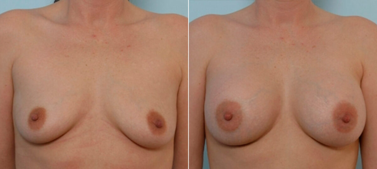 Breast Augmentation before and after photos in Houston, TX, Patient 25366