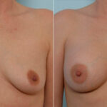 Breast Augmentation before and after photos in Houston, TX, Patient 25366