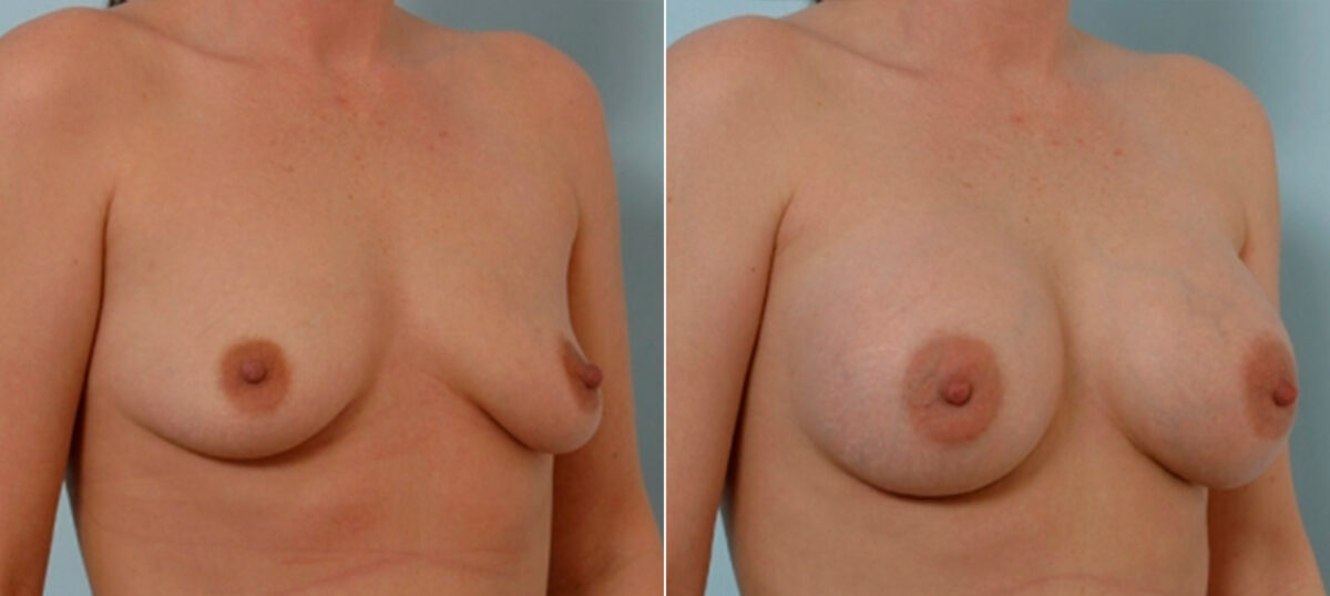 Breast Augmentation before and after photos in Houston, TX, Patient 25366