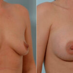 Breast Augmentation before and after photos in Houston, TX, Patient 25366