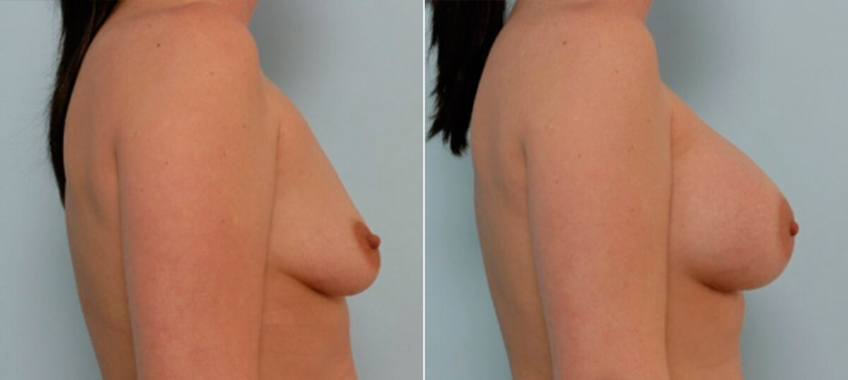 Breast Augmentation before and after photos in Houston, TX, Patient 25366