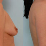 Breast Augmentation before and after photos in Houston, TX, Patient 25366