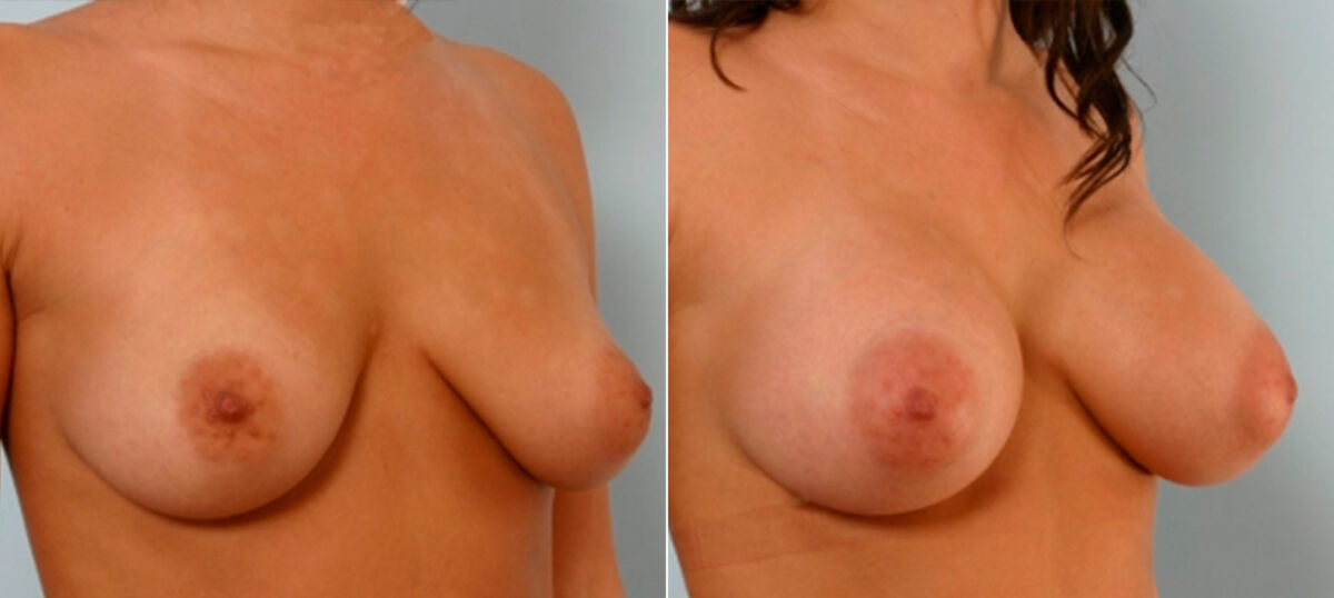 Breast Augmentation before and after photos in Houston, TX, Patient 25373