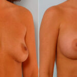Breast Augmentation before and after photos in Houston, TX, Patient 25378