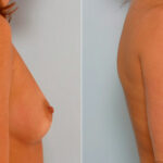 Breast Augmentation before and after photos in Houston, TX, Patient 25378