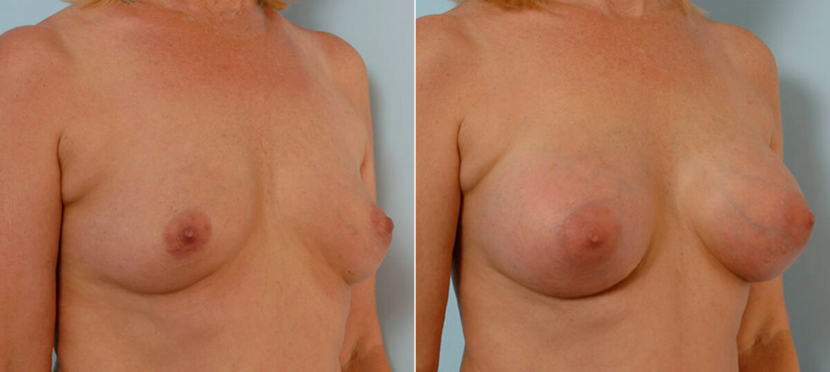 Breast Augmentation before and after photos in Houston, TX, Patient 25385