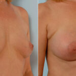 Breast Augmentation before and after photos in Houston, TX, Patient 25385
