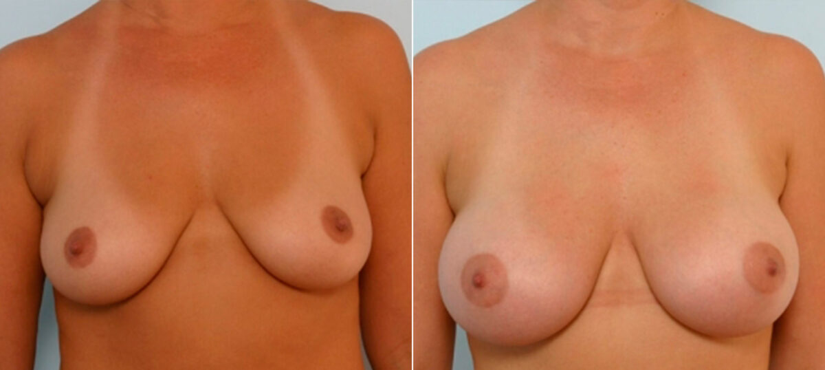Breast Augmentation before and after photos in Houston, TX, Patient 25392