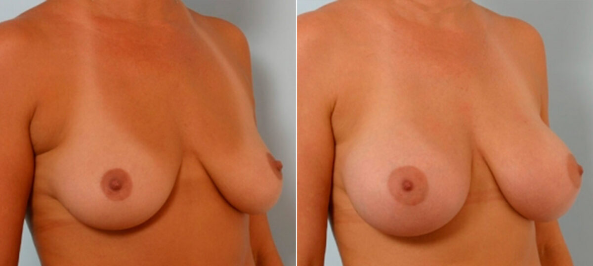 Breast Augmentation before and after photos in Houston, TX, Patient 25392