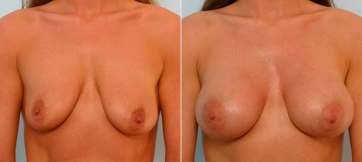 Breast Augmentation before and after photos in Houston, TX, Patient 25399