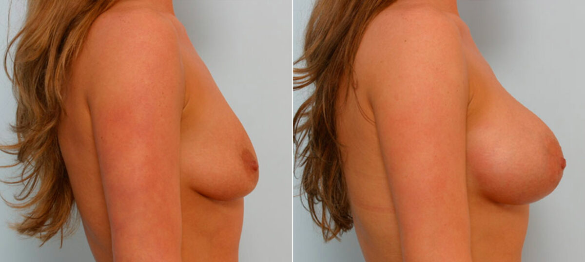 Breast Augmentation before and after photos in Houston, TX, Patient 25399