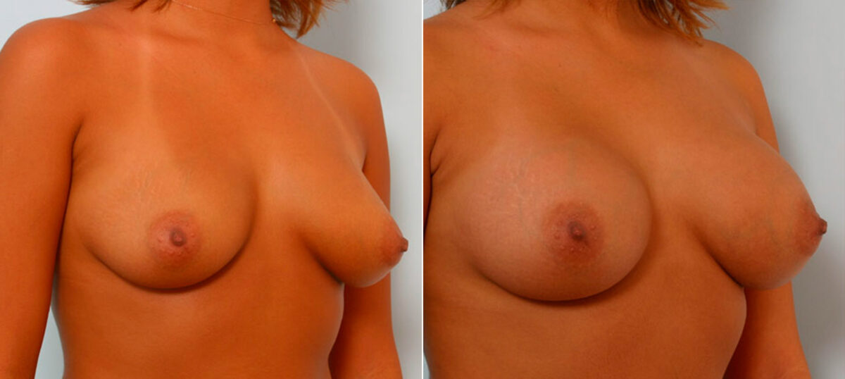 Breast Augmentation before and after photos in Houston, TX, Patient 25406