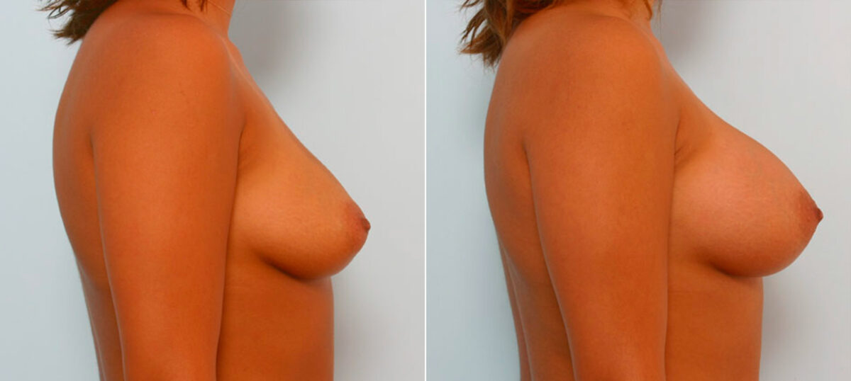 Breast Augmentation before and after photos in Houston, TX, Patient 25406