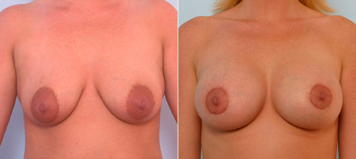 Breast Augmentation before and after photos in Houston, TX, Patient 25413
