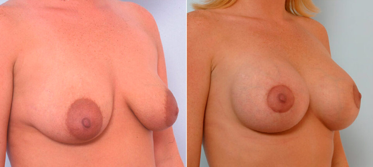 Breast Augmentation before and after photos in Houston, TX, Patient 25413