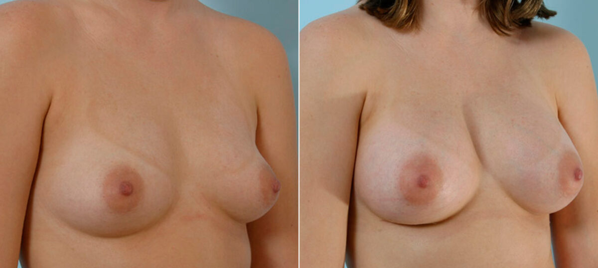 Breast Augmentation before and after photos in Houston, TX, Patient 25420