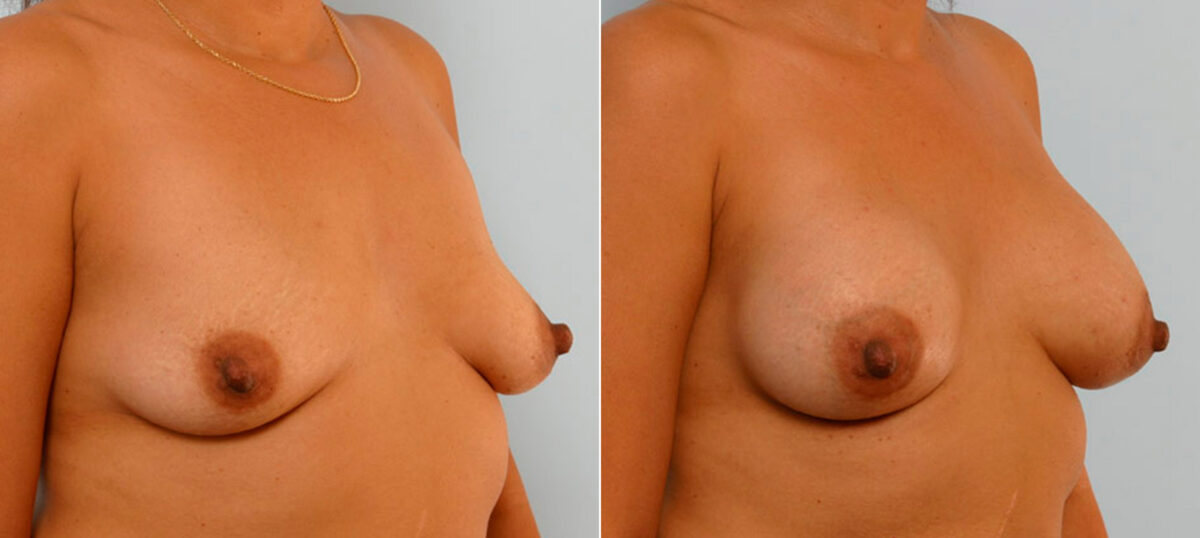 Breast Augmentation before and after photos in Houston, TX, Patient 25427