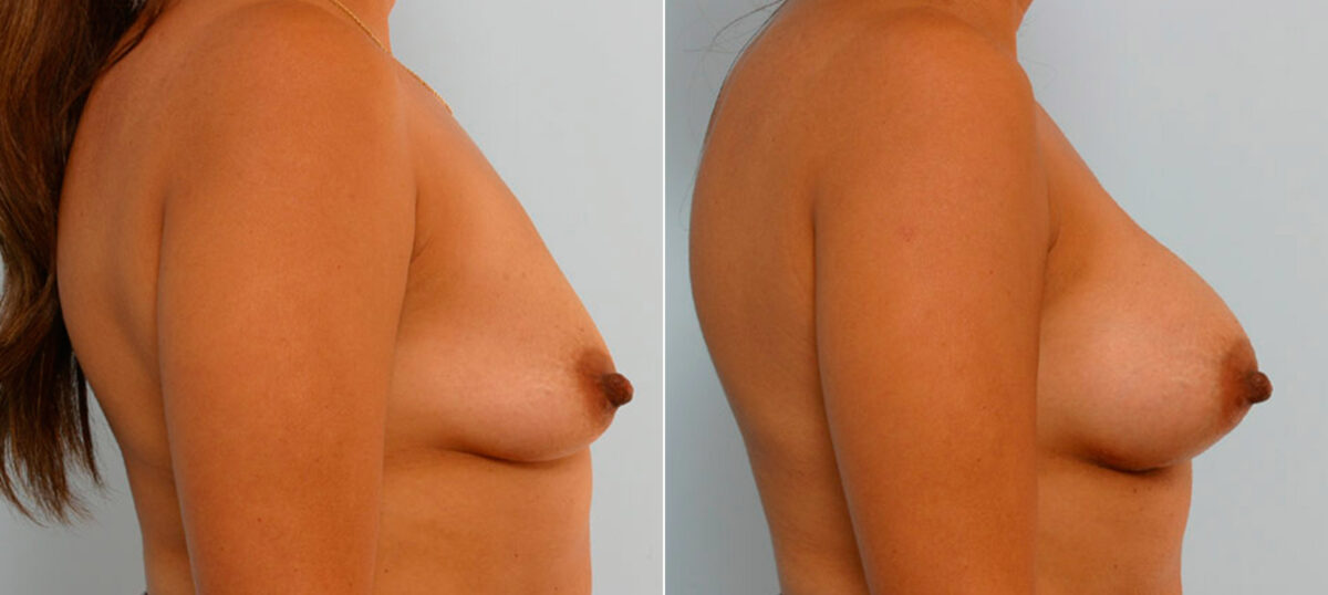 Breast Augmentation before and after photos in Houston, TX, Patient 25427