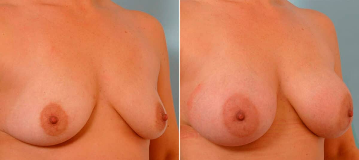 Breast Augmentation before and after photos in Houston, TX, Patient 25434