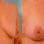 Breast Augmentation before and after photos in Houston, TX, Patient 25434