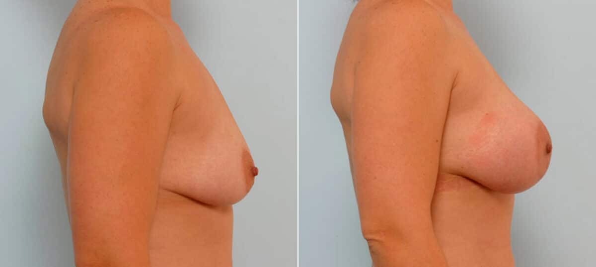 Breast Augmentation before and after photos in Houston, TX, Patient 25434