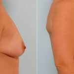 Breast Augmentation before and after photos in Houston, TX, Patient 25434
