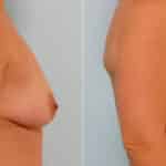 Breast Augmentation before and after photos in Houston, TX, Patient 25434