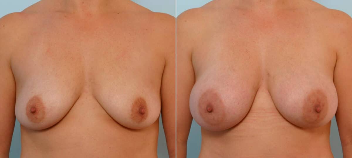 Breast Augmentation before and after photos in Houston, TX, Patient 25434