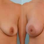 Breast Augmentation before and after photos in Houston, TX, Patient 25434