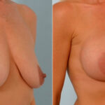 Breast Augmentation before and after photos in Houston, TX, Patient 25441