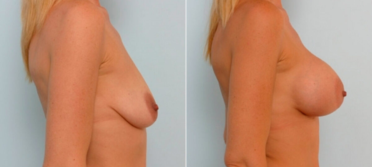 Breast Augmentation before and after photos in Houston, TX, Patient 25441