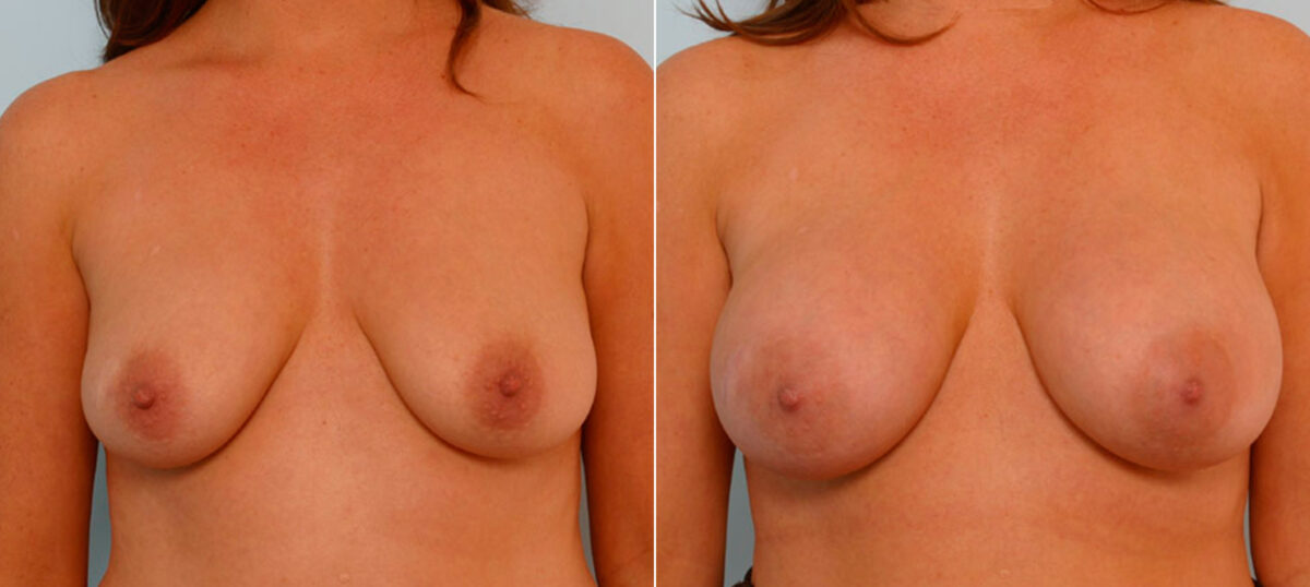 Breast Augmentation before and after photos in Houston, TX, Patient 25446