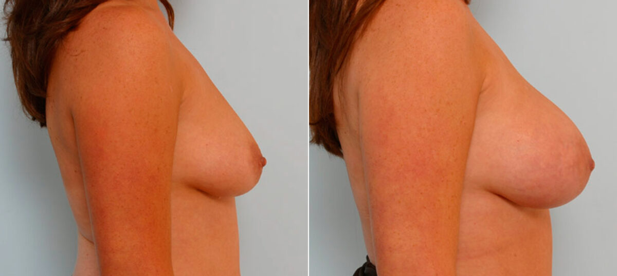 Breast Augmentation before and after photos in Houston, TX, Patient 25446