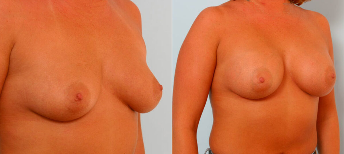 Breast Augmentation before and after photos in Houston, TX, Patient 25453