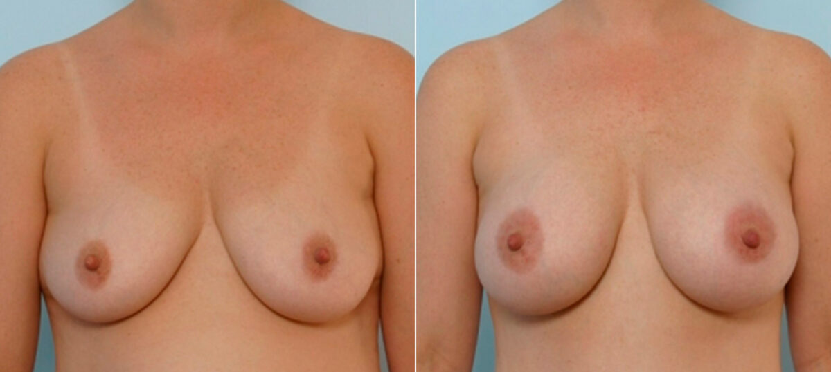 Breast Augmentation before and after photos in Houston, TX, Patient 25460