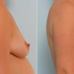 Breast Augmentation before and after photos in Houston, TX, Patient 25460