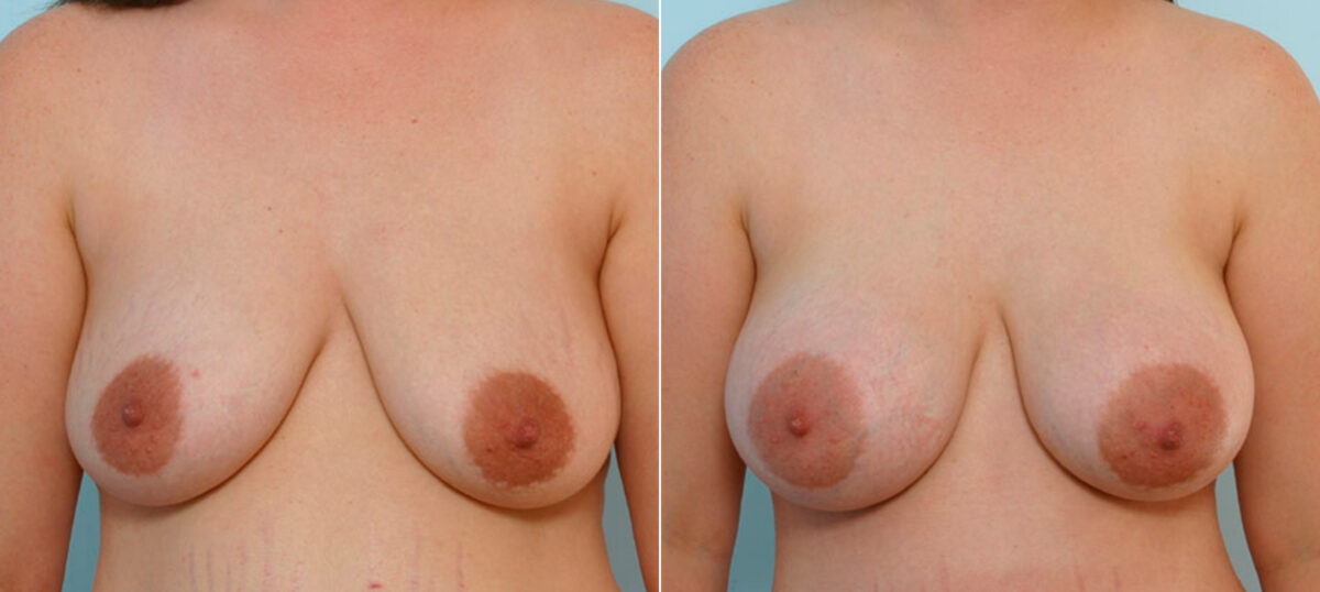 Breast Augmentation before and after photos in Houston, TX, Patient 25467