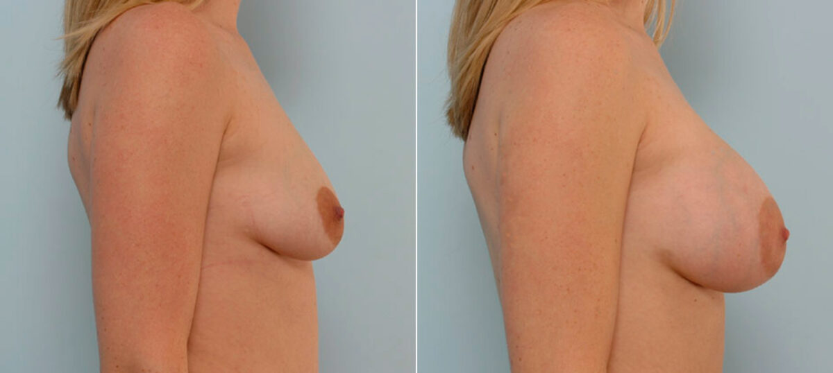 Breast Augmentation before and after photos in Houston, TX, Patient 25474