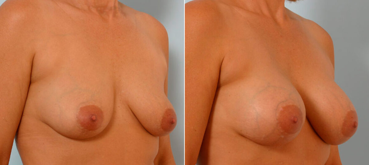 Breast Augmentation before and after photos in Houston, TX, Patient 25481