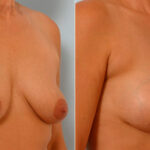 Breast Augmentation before and after photos in Houston, TX, Patient 25481